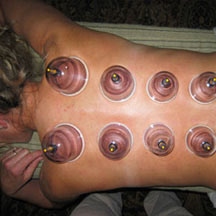 cupping